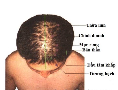 Huyệt Thừa Linh - Y CỔ TRUYỀN