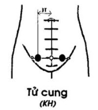 Huyệt Tử Cung - Y CỔ TRUYỀN